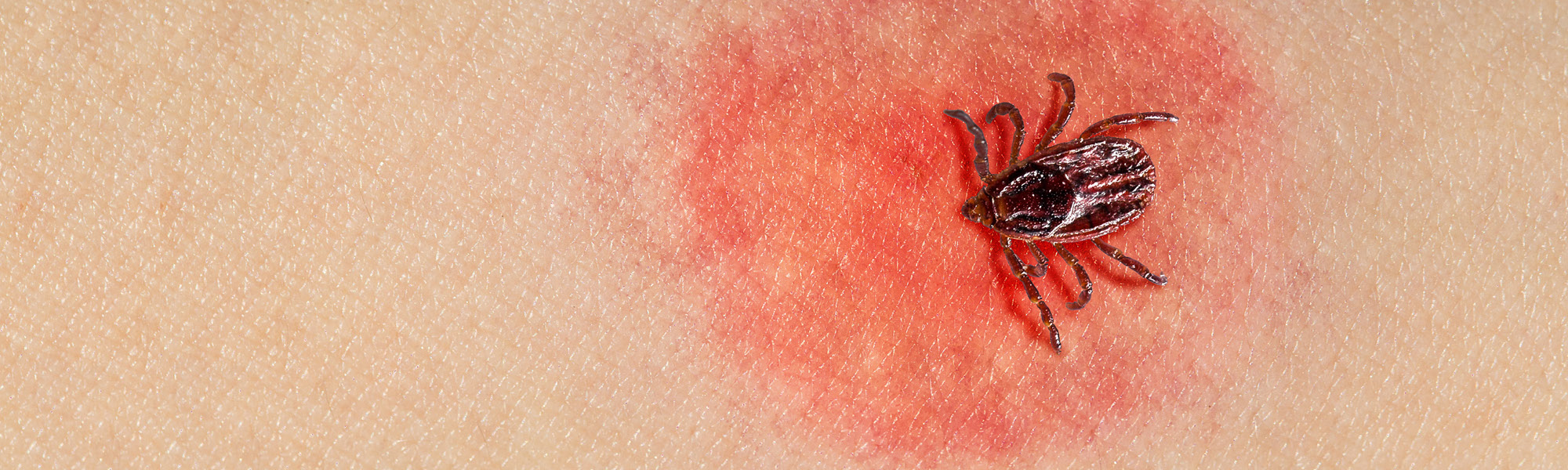 Yard Treatment for Ticks in Iowa Preferred Pest Control